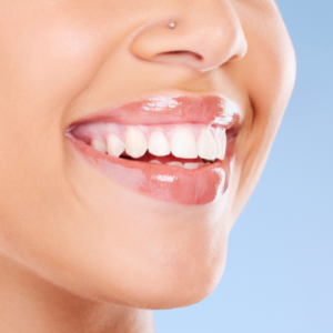 A woman smiling with veneers